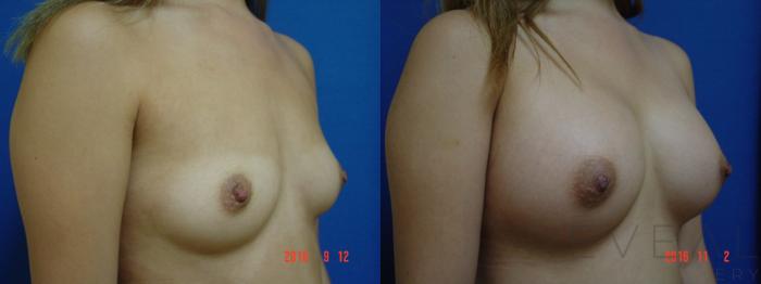 Before & After Breast Augmentation Case 204 View #3 View in San Jose, CA