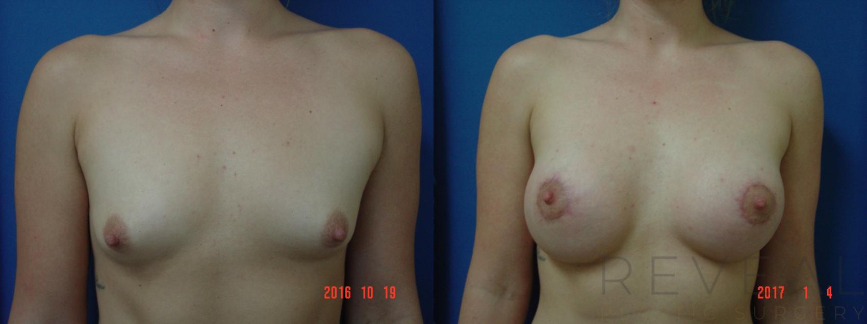 Before & After Breast Augmentation Case 205 View #1 View in San Jose, CA