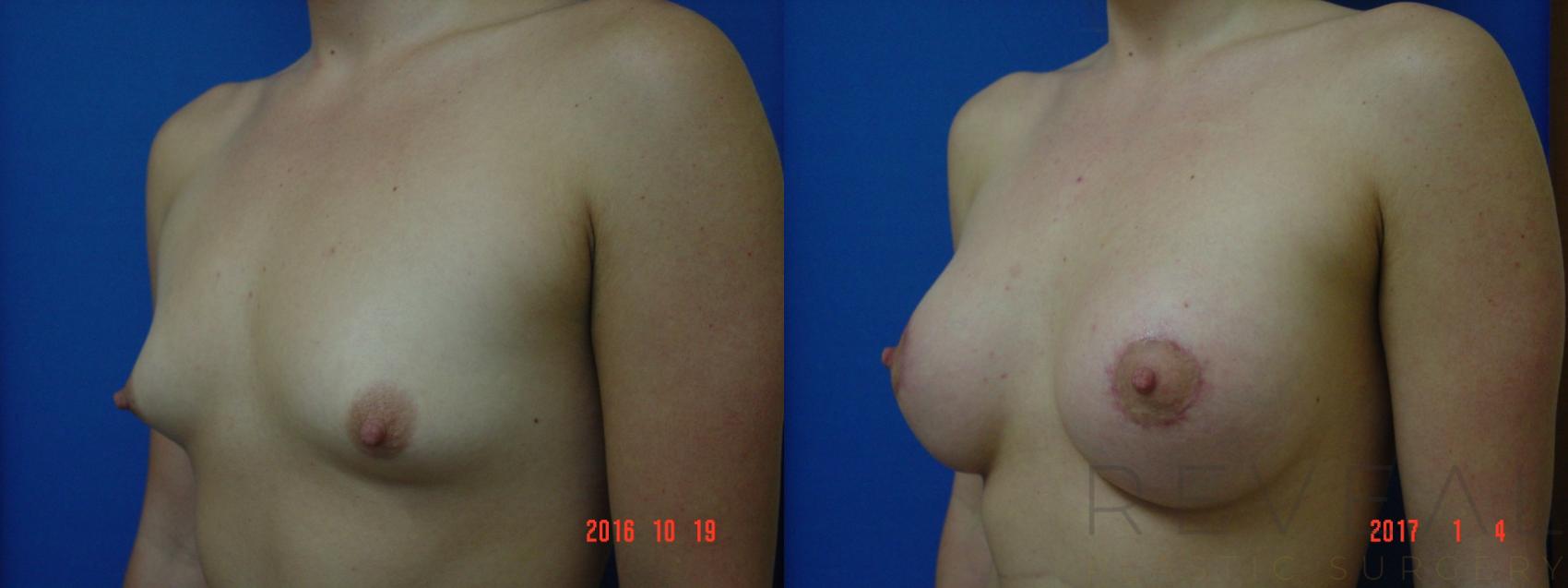Before & After Breast Lift Case 205 View #2 View in San Jose, CA