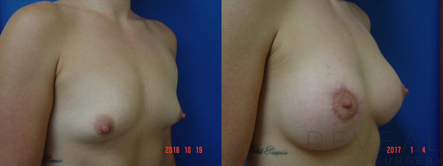 Before & After Breast Lift Case 205 View #3 View in San Jose, CA