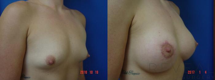 Before & After Breast Augmentation Case 205 View #3 View in San Jose, CA