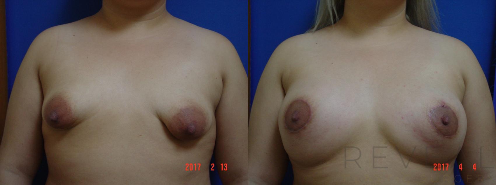 Before & After Breast Augmentation Case 212 View #1 View in San Jose, CA