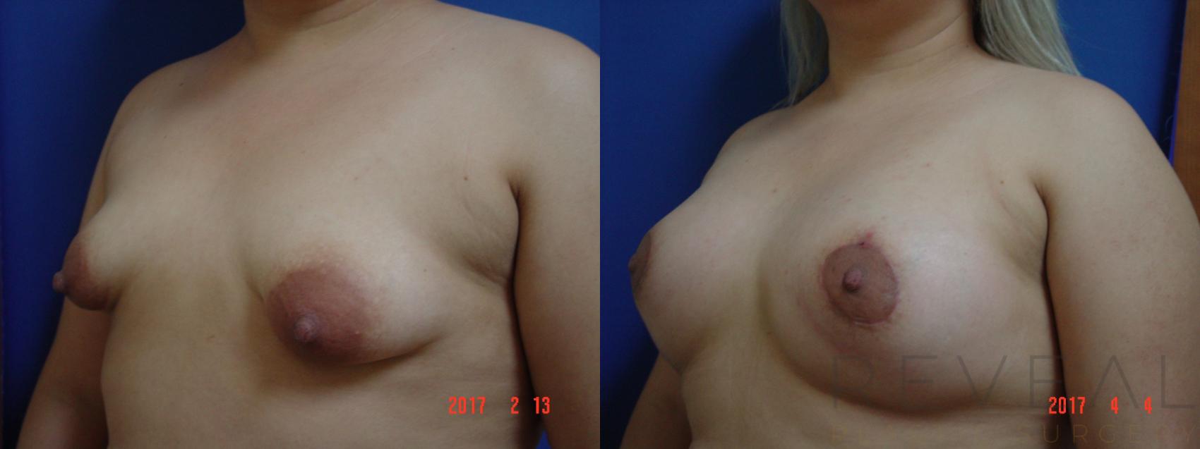 Before & After Breast Lift Case 212 View #2 View in San Jose, CA