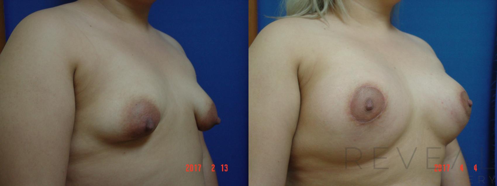 Before & After Breast Lift Case 212 View #3 View in San Jose, CA