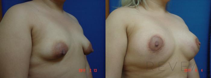 Before & After Breast Augmentation Case 212 View #3 View in San Jose, CA