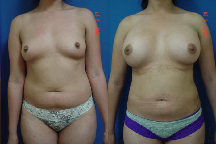 Before & After Liposuction Case 217 View #1 View in San Jose, CA