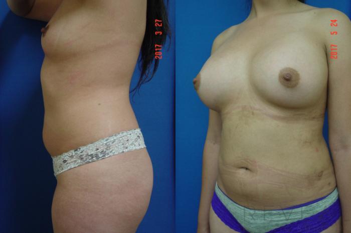 Before & After Breast Augmentation Case 217 View #3 View in San Jose, CA