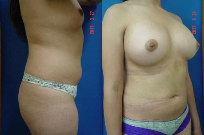 Before & After Breast Augmentation Case 217 View #4 View in San Jose, CA