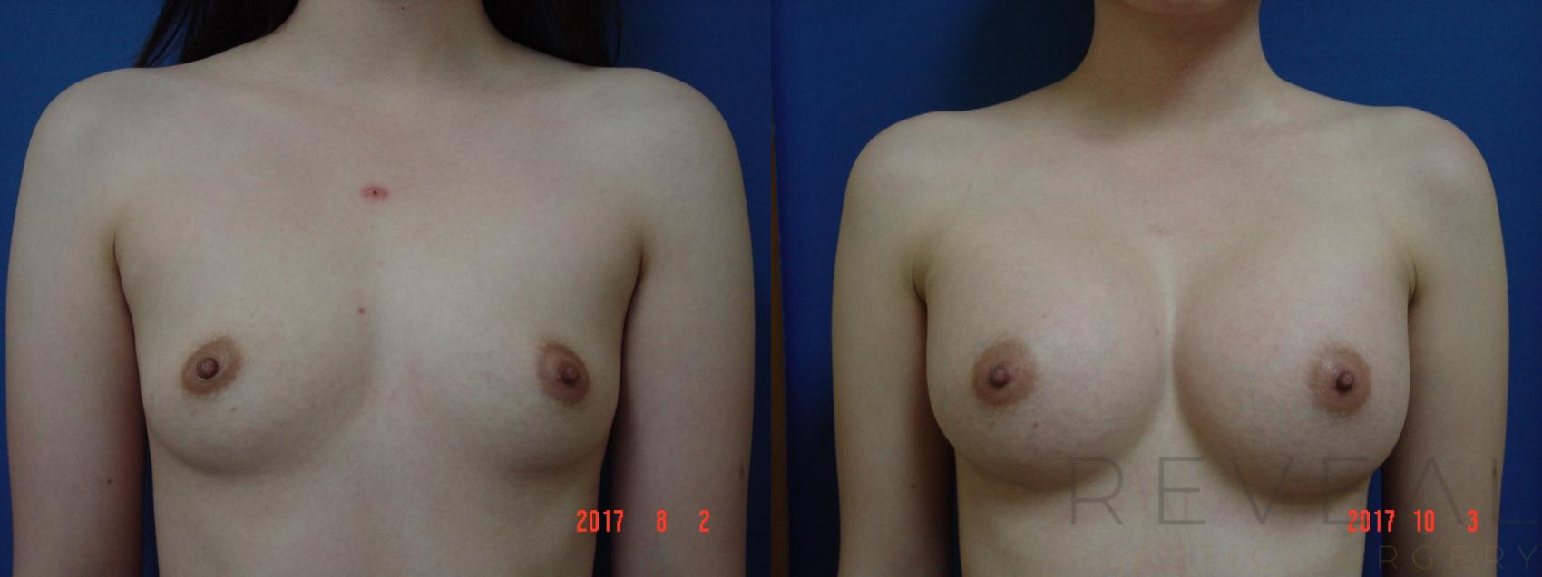 Before & After Breast Augmentation Case 227 View #1 View in San Jose, CA