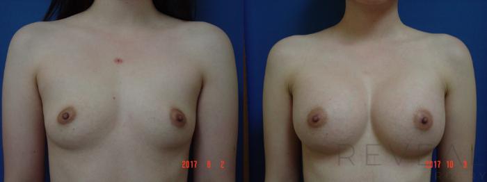 Before & After Breast Augmentation Case 227 View #1 View in San Jose, CA