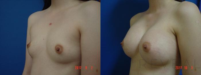 Before & After Breast Augmentation Case 227 View #2 View in San Jose, CA