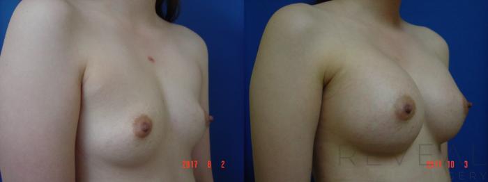 Before & After Breast Augmentation Case 227 View #3 View in San Jose, CA