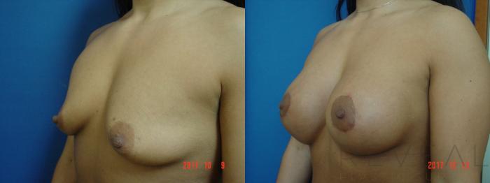 Before & After Breast Augmentation Case 237 View #2 View in San Jose, CA