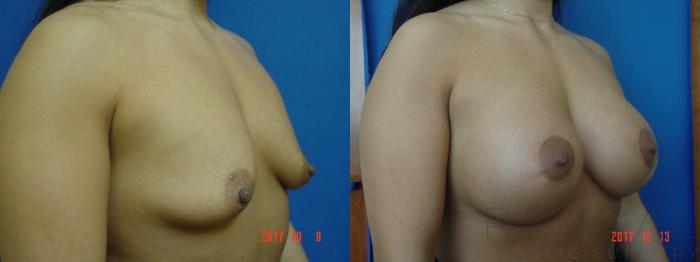 Before & After Breast Augmentation Case 237 View #3 View in San Jose, CA
