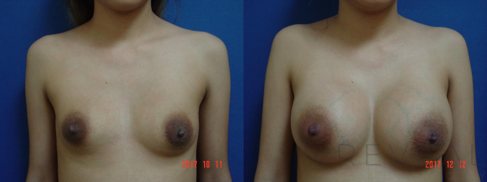 Before & After Breast Augmentation Case 238 View #1 View in San Jose, CA