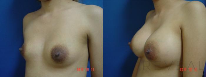 Before & After Breast Augmentation Case 238 View #2 View in San Jose, CA