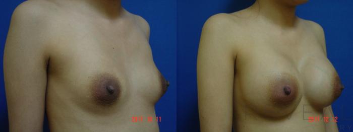 Before & After Breast Augmentation Case 238 View #3 View in San Jose, CA