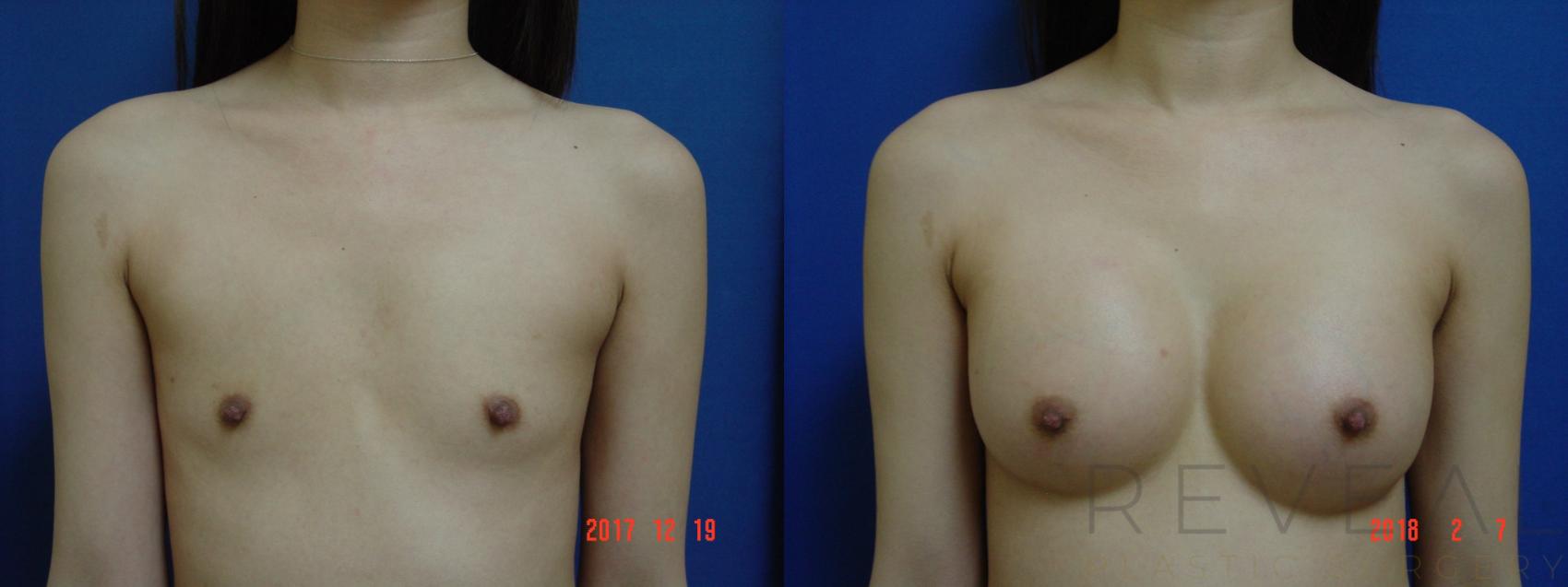 Before & After Breast Augmentation Case 240 View #1 View in San Jose, CA