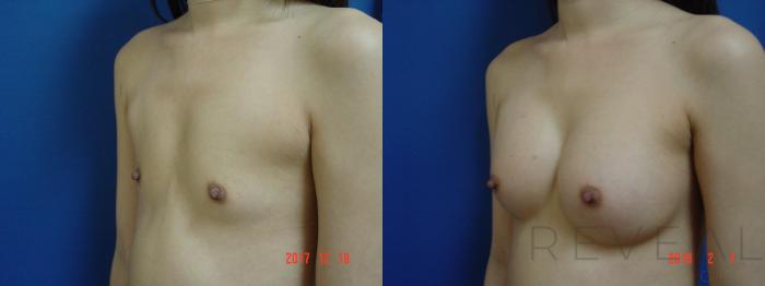 Before & After Breast Augmentation Case 240 View #2 View in San Jose, CA