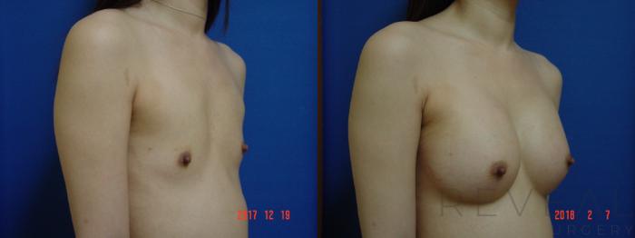 Before & After Breast Augmentation Case 240 View #3 View in San Jose, CA