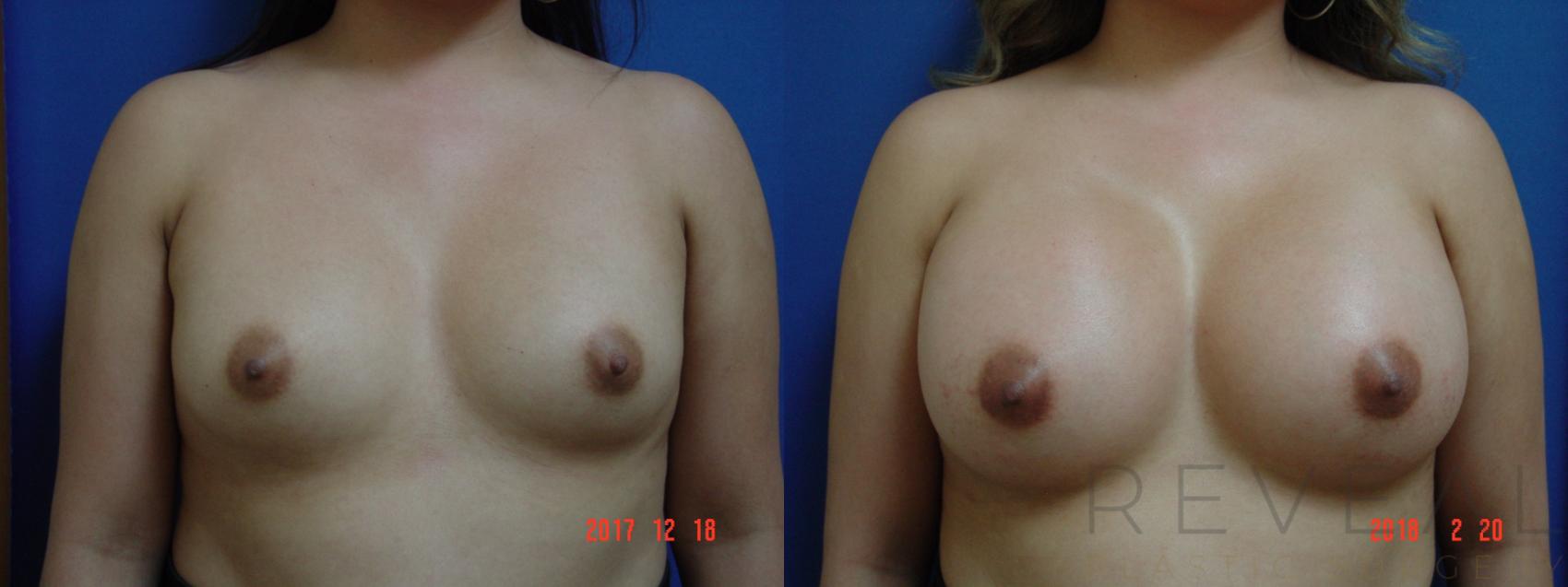 Before & After Breast Augmentation Case 242 View #1 View in San Jose, CA