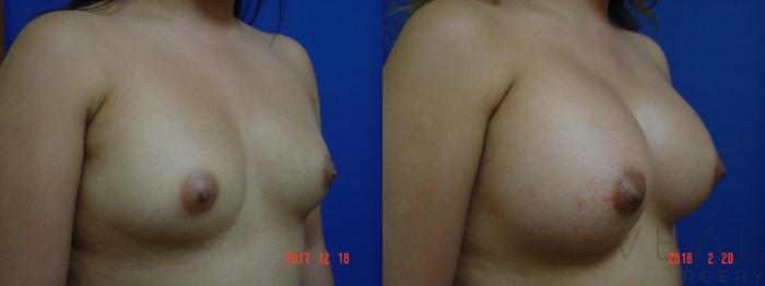 Before & After Breast Augmentation Case 242 View #3 View in San Jose, CA