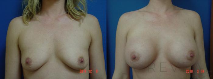Before & After Breast Augmentation Case 244 View #1 View in San Jose, CA