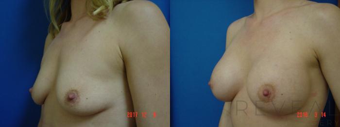 Before & After Breast Augmentation Case 244 View #2 View in San Jose, CA