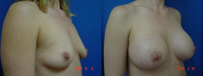 Before & After Breast Augmentation Case 244 View #3 View in San Jose, CA