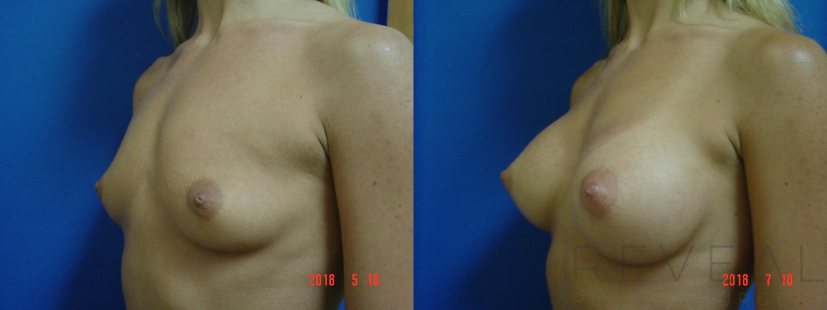 Before & After Breast Augmentation Case 246 View #1 View in San Jose, CA