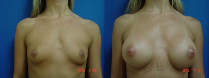 Before & After Breast Augmentation Case 246 View #2 View in San Jose, CA