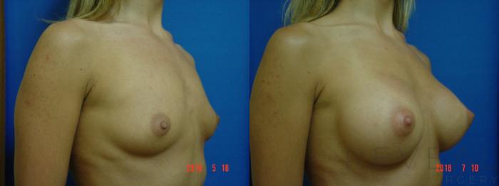Before & After Breast Augmentation Case 246 View #3 View in San Jose, CA