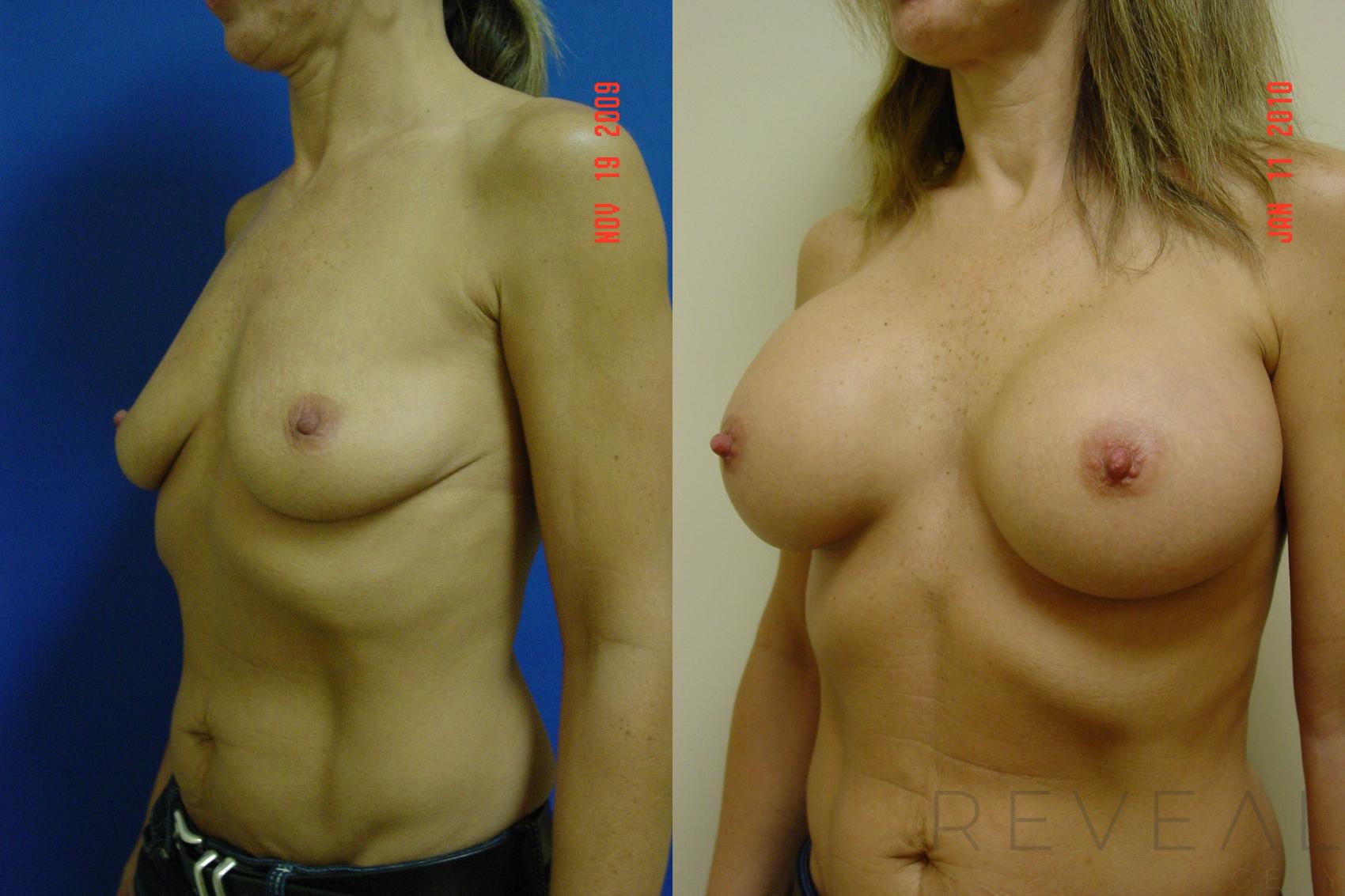 Before & After Breast Augmentation Case 25 View #1 View in San Jose, CA
