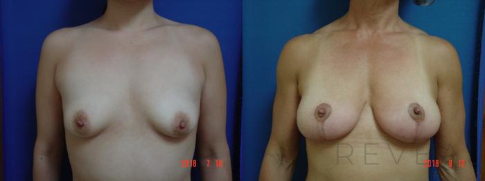 Before & After Breast Lift Case 256 View #1 View in San Jose, CA