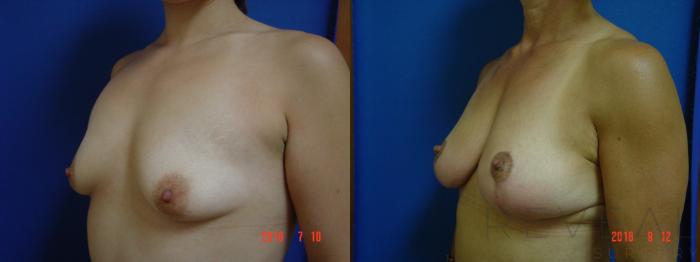 Before & After Breast Augmentation Case 256 View #2 View in San Jose, CA