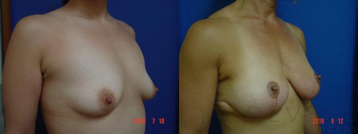 Before & After Breast Augmentation Case 256 View #3 View in San Jose, CA
