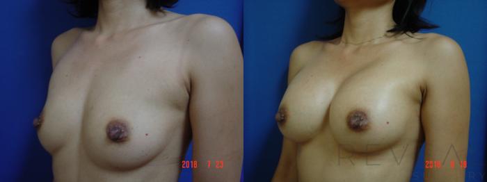 Before & After Breast Augmentation Case 257 View #2 View in San Jose, CA