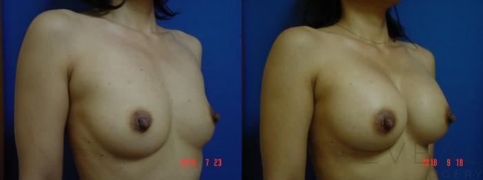 Before & After Breast Augmentation Case 257 View #3 View in San Jose, CA