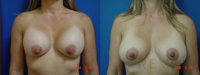 Before & After Breast Augmentation Case 259 View #1 View in San Jose, CA