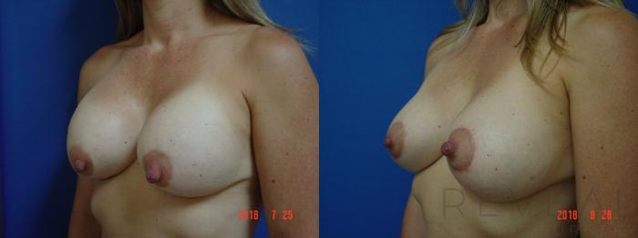 Before & After Breast Augmentation Case 259 View #2 View in San Jose, CA