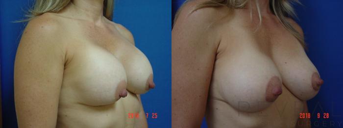 Before & After Breast Augmentation Case 259 View #3 View in San Jose, CA