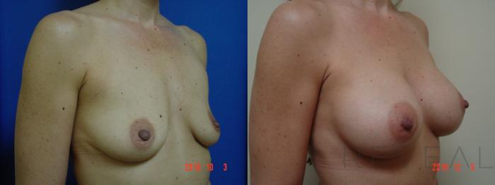 Before & After Breast Augmentation Case 278 View #1 View in San Jose, CA