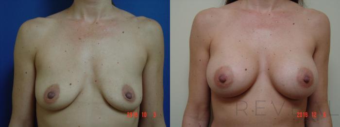 Before & After Breast Augmentation Case 278 View #2 View in San Jose, CA