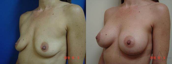 Before & After Breast Augmentation Case 278 View #3 View in San Jose, CA