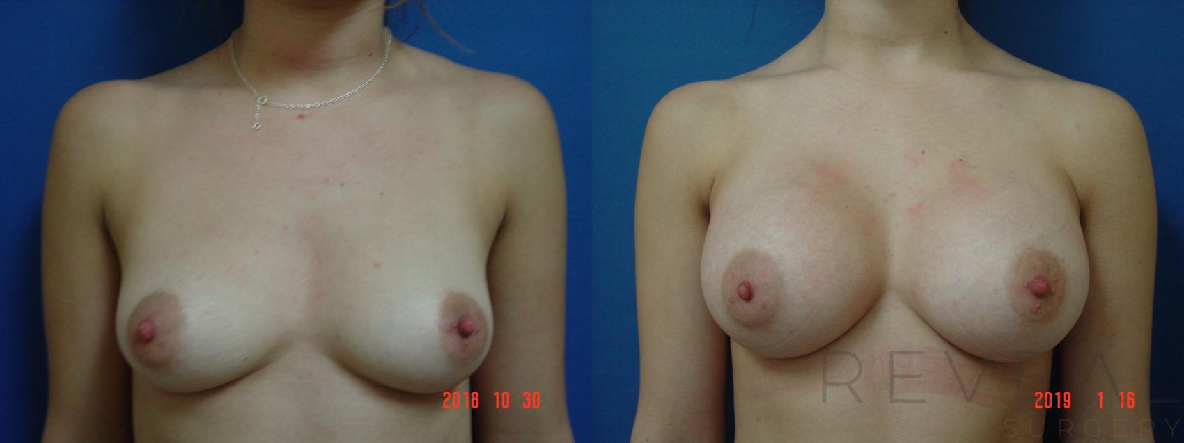Before & After Breast Augmentation Case 284 View #1 View in San Jose, CA