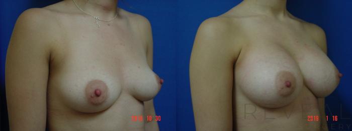 Before & After Breast Augmentation Case 284 View #2 View in San Jose, CA