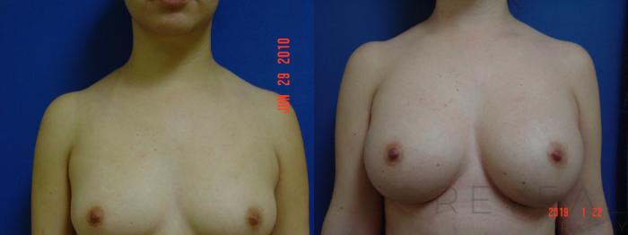 Before & After Breast Augmentation Case 286 View #1 View in San Jose, CA