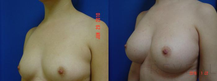 Before & After Breast Augmentation Case 286 View #2 View in San Jose, CA