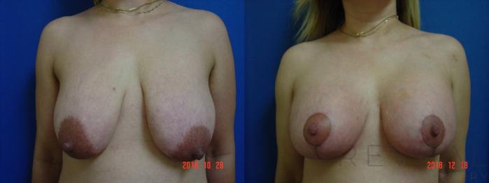 Before & After Breast Augmentation Case 300 View #1 View in San Jose, CA