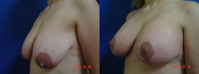 Before & After Breast Augmentation Case 300 View #2 View in San Jose, CA
